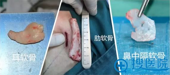 上海百达丽王艳解说肋软骨、鼻中隔、耳软骨三种隆鼻材料如何选