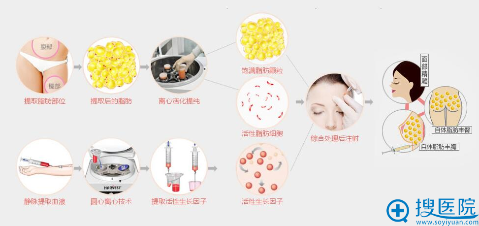 深圳希思整形做的自体脂肪填充怎么样 价格表+整形案例对比图