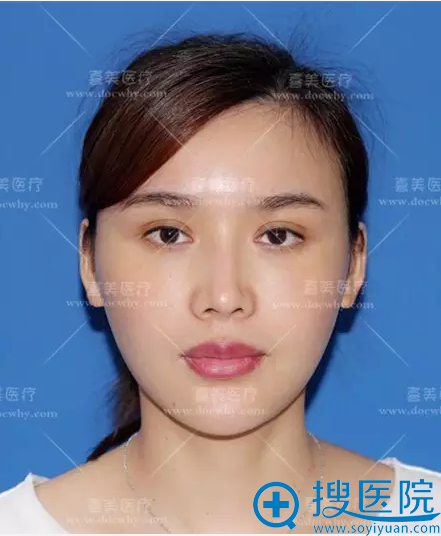 上海喜美整形医院王会勇曲妙轩鼻综合修复案例 12万元重获美鼻