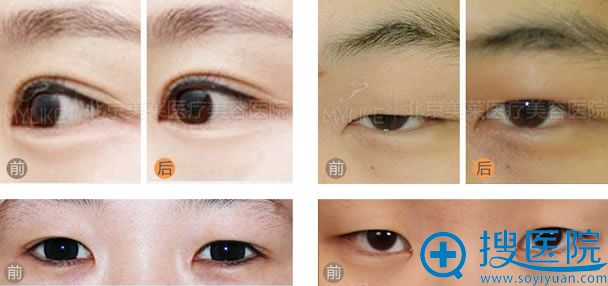 北京美莱双眼眼整形代表案例 北京美莱双眼眼整形代表案例