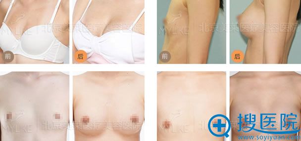 北京美莱整形假体隆胸案例图 北京美莱整形假体隆胸案例图