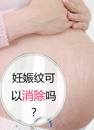 妊娠纹可以消除吗?杭州时光宝妈体验激光祛妊娠纹真实经历