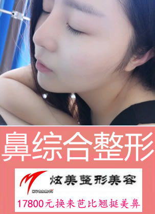 北京炫美徐学东硅胶自体耳软骨隆鼻案例 17800换来芭比翘挺美鼻