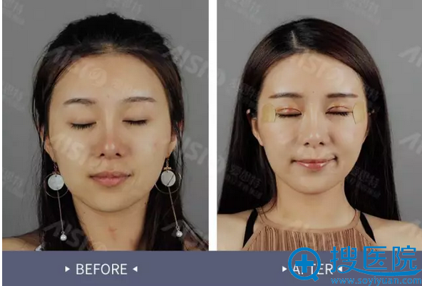 灵韵精雕大眼术术后第3天闭眼对比 灵韵精雕大眼术术后第3天闭眼对比