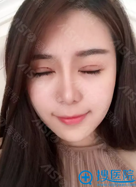灵韵精雕大眼术术后7天拆线效果 灵韵精雕大眼术术后7天拆线效果