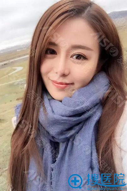 术后一个半月效果 术后一个半月效果