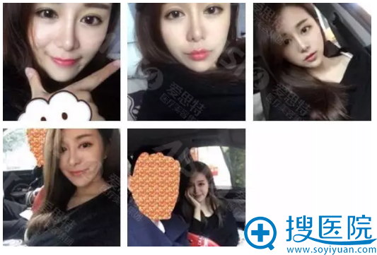 灵韵精雕大眼术术后两个月生活照 灵韵精雕大眼术术后两个月生活照