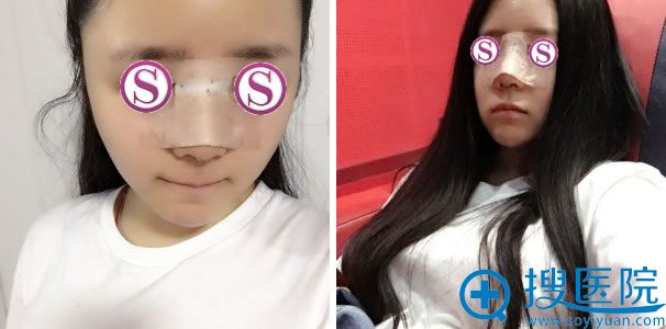 在<!--<i data=20240710 data-id=12618></i>-->做完隆鼻后第4天 在<!--<i data=20240710 data-id=12618></i>-->做完隆鼻后第4天