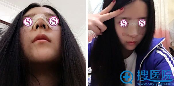 <!--<i data=20240710 data-id=12618></i>-->做假体隆鼻手术第七天 <!--<i data=20240710 data-id=12618></i>-->做假体隆鼻手术第七天