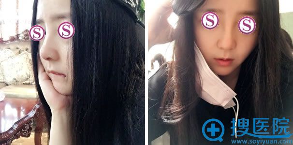 隆鼻手术拆线后效果照片 隆鼻手术拆线后效果照片
