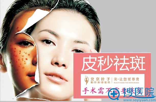 皮秒激光祛斑手术恢复注意事项 皮秒激光祛斑手术恢复注意事项