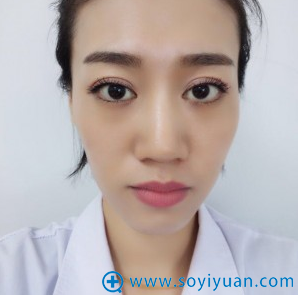 北京圣嘉新医院邱立东面部自体脂肪填充案例 让我拥有少女脸