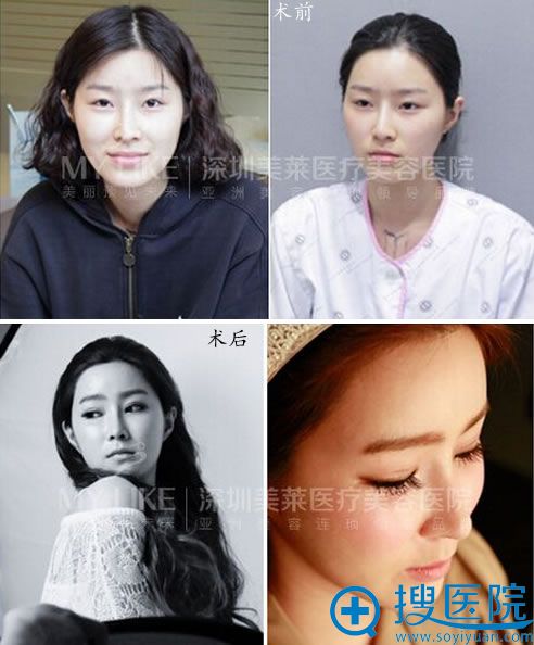 深圳美莱整形美容医院双眼皮案例 深圳美莱整形美容医院双眼皮案例