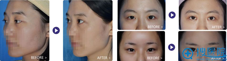深圳米兰柏羽医学美容医院双眼皮案例 深圳米兰柏羽医学美容医院双眼皮案例