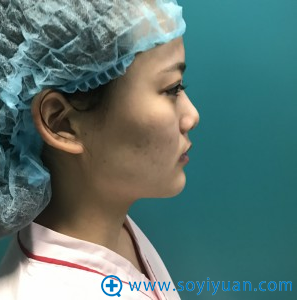 上海百达丽整形医院韩嘉毅医生鼻综合隆鼻案例 4万多元收获美鼻