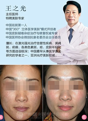 广州曙光王之光教授激光祛斑案例 让我立刻拥有洁白无瑕的脸蛋