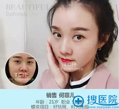 祛斑前后对比效果_重庆时光 祛斑前后对比效果_重庆时光