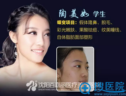 沈阳百嘉丽师生整形案例一 沈阳百嘉丽师生整形案例一