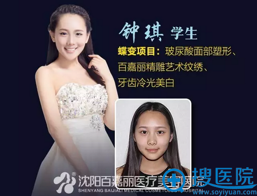 沈阳百嘉丽师生整形案例二 沈阳百嘉丽师生整形案例二