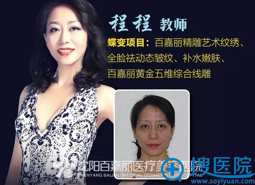 沈阳百嘉丽师生整形案例四 沈阳百嘉丽师生整形案例四
