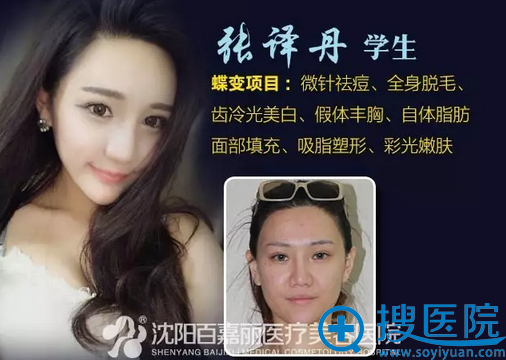 沈阳百嘉丽师生整形案例三 沈阳百嘉丽师生整形案例三