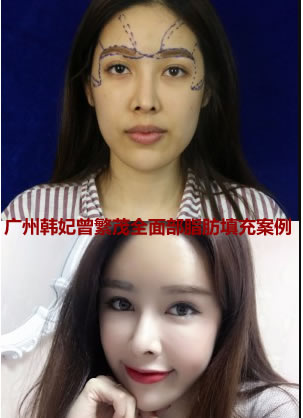 广州韩妃曾繁茂全面部脂肪填充案例 立刻打造饱满童颜脸