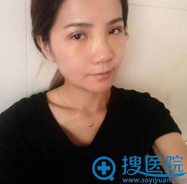 术后四天差不多消肿了 术后四天差不多消肿了