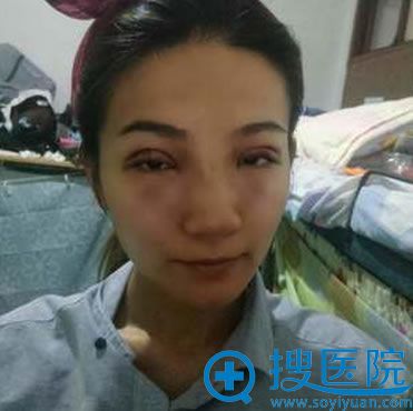 深圳晨曦吉梅斯双眼皮术后40天恢复过程图 从一线天到芭比眼