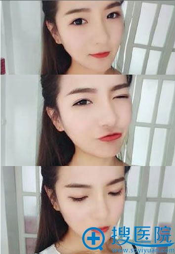 术后50天睁眼闭眼效果图 术后50天睁眼闭眼效果图