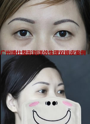 广州博仕整形刘洋仿生理双眼皮真实案例 让我拥有天生美丽电眼