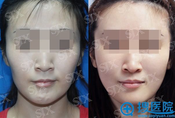 北京圣嘉新自体脂肪填充面部案例 北京圣嘉新自体脂肪填充面部案例