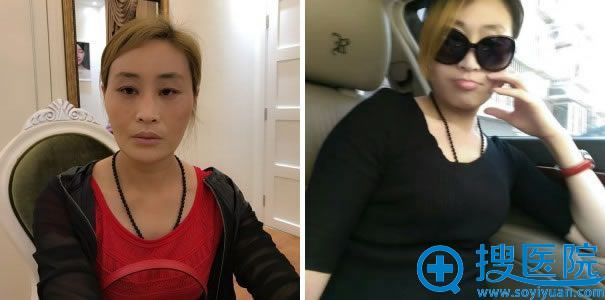禾美嘉任学会全面部填充前后效果对比照片 禾美嘉任学会全面部填充前后效果对比照片