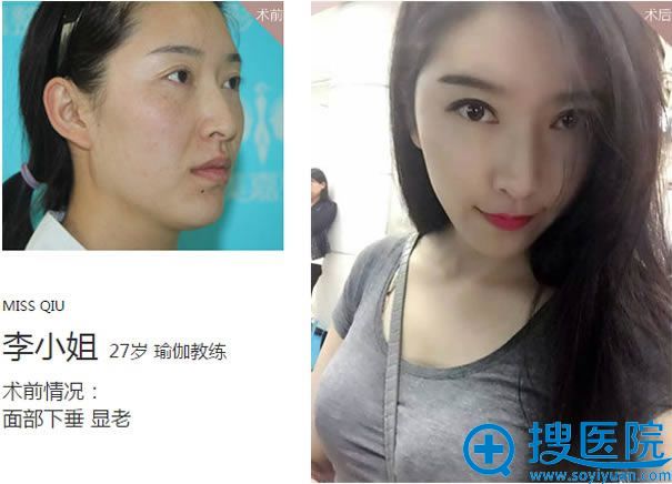 北京禾美嘉魔V面部钻石微雕案例 北京禾美嘉魔V面部钻石微雕案例