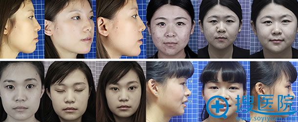北京丽都整形医院成功案例图 北京丽都整形医院成功案例图
