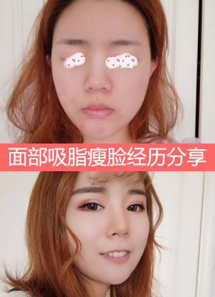 北京悦美好医整形公立名医甘承面部吸脂案例 瘦出精致上镜脸