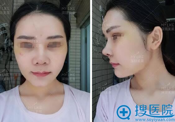 恢复期的正面侧面照 恢复期的正面侧面照