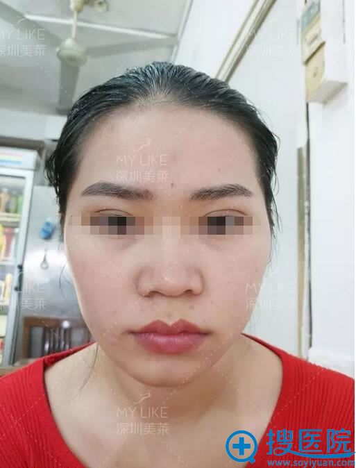 【真人经历】深圳美莱李战强达拉斯隆鼻隆下颌面部脂肪填充案例