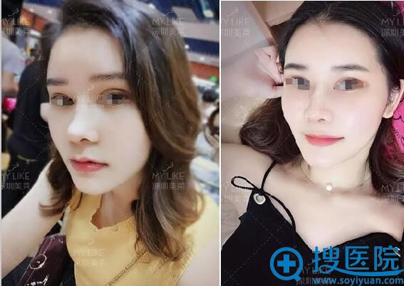 术后一个月恢复效果 术后一个月恢复效果