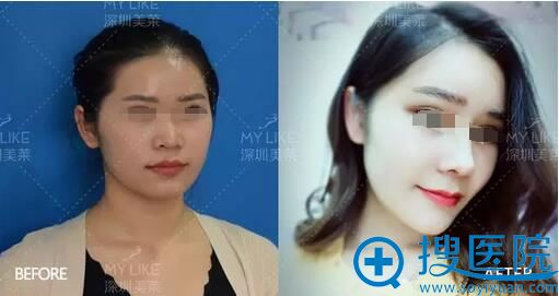 手术前后对比照 手术前后对比照