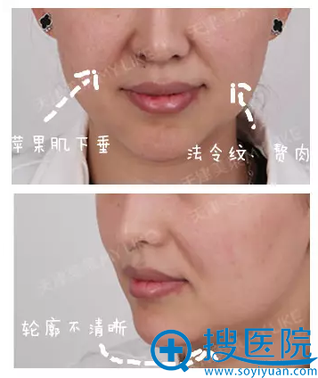 【真人秀】天津美莱整形医院神奇面部线雕 让我自带上镜小V脸