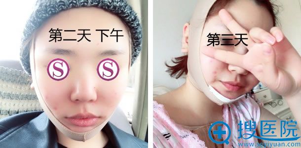 做完面部吸脂手术第三天 做完面部吸脂手术第三天