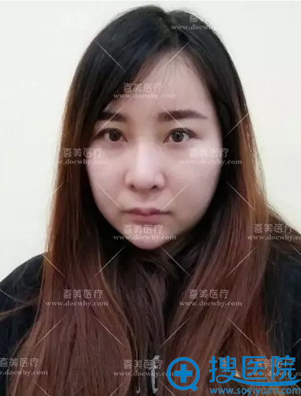 真实案例揭秘上海喜美隆鼻怎么样 大鼻头改善后变身混血美女