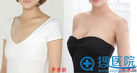 西安西美自体脂肪隆胸案例 西安西美自体脂肪隆胸案例