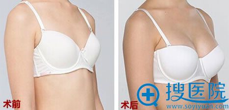 西美隆胸前后对比效果 西美隆胸前后对比效果