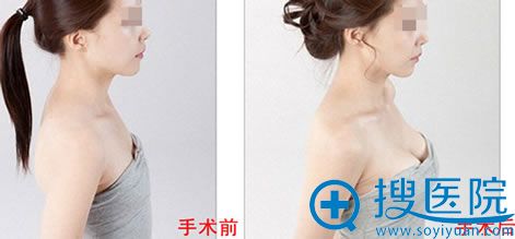 <!--<i data=20240710 data-id=13942></i>-->外科丰胸对比照 <!--<i data=20240710 data-id=13942></i>-->外科丰胸对比照