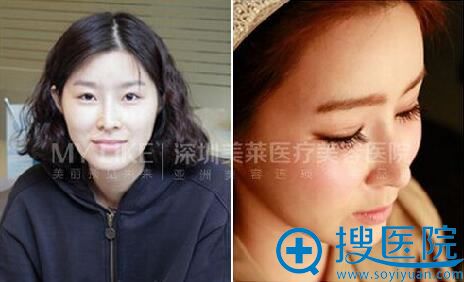 深圳美莱眼梁志为双眼皮术后效果对比 深圳美莱眼梁志为双眼皮术后效果对比