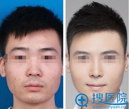 深圳美莱梁晓健隆鼻案例 深圳美莱梁晓健隆鼻案例