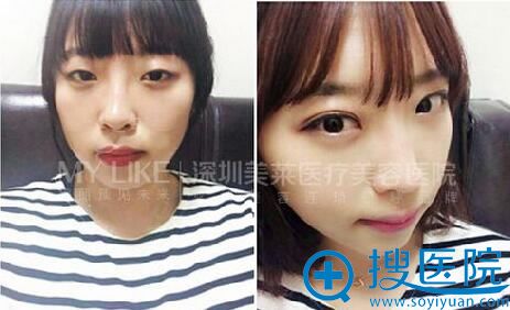 深圳美莱陈磊双眼皮案例 深圳美莱陈磊双眼皮案例