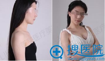 深圳美莱徐英隆胸案例 深圳美莱徐英隆胸案例