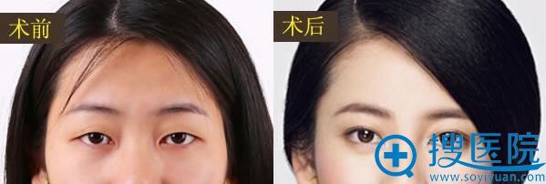 <!--<i data=20240710 data-id=12045></i>-->整形美容医院开眼角前后对比效果 <!--<i data=20240710 data-id=12045></i>-->整形美容医院开眼角前后对比效果